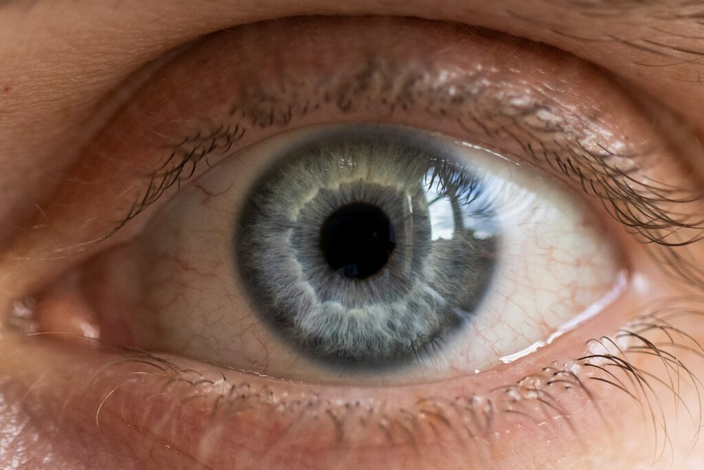 Close-up clinical view of the eye's surface, relevant to diagnosing and treating pterygium